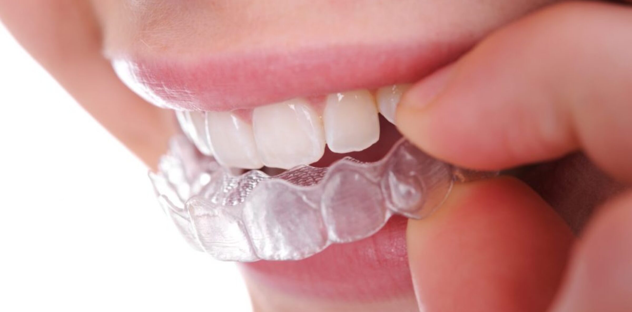 blog inner thumb :Absolute dental new Dental